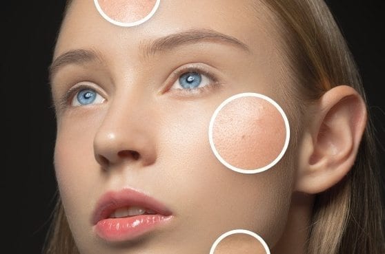 face acne